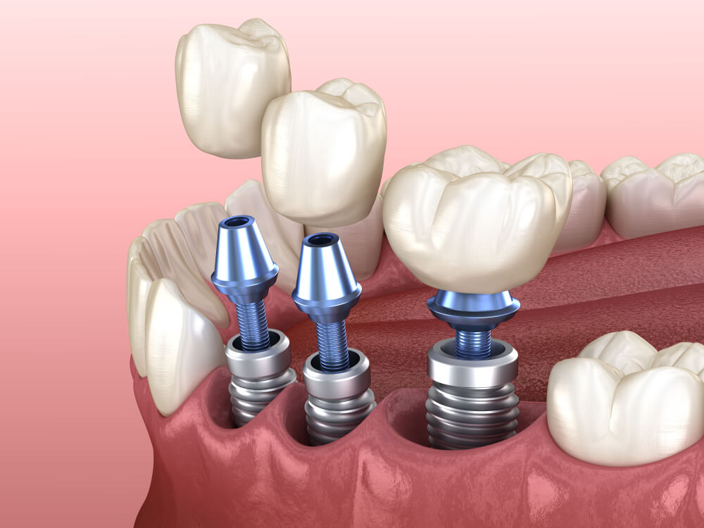 implant protez